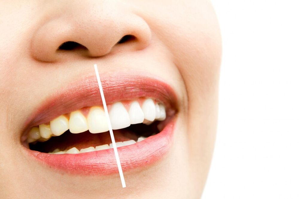 tips to reduce pain when whitening sensitive teeth